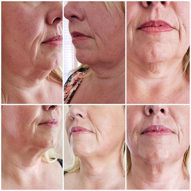 Lift and tighten results