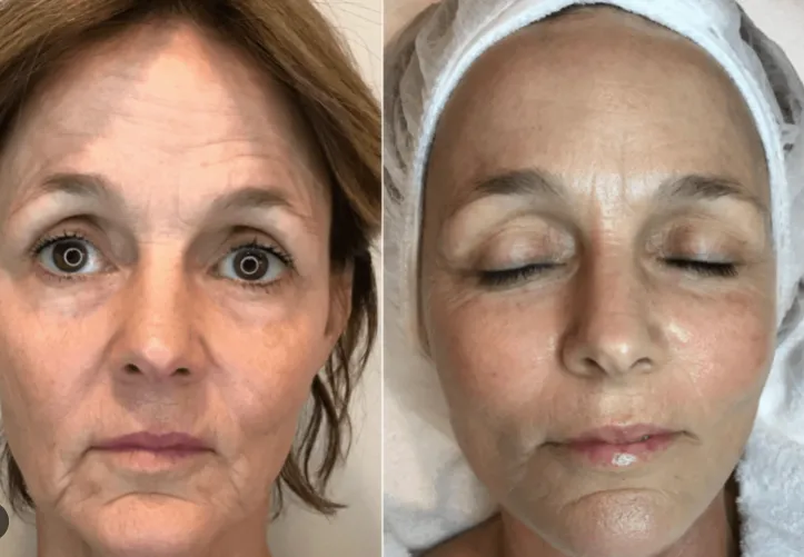 Before and after results