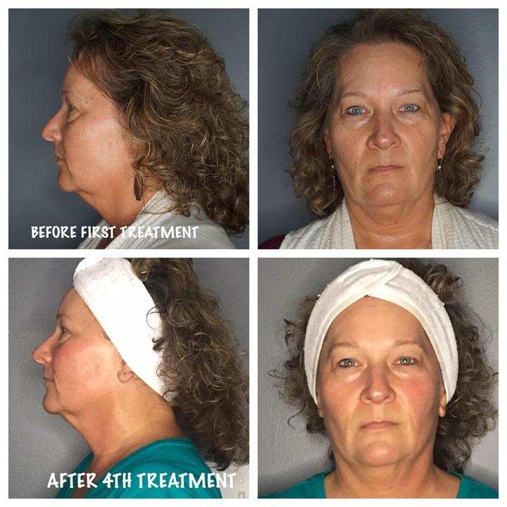 Neck and jawline results